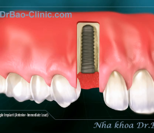 Implant Đà Nẵng