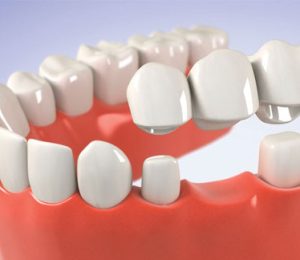 Porcelain Dental Bridge