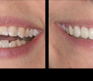 WHAT IS DENTAL VENEERS?