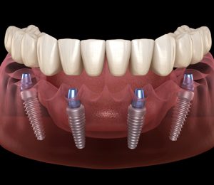 (Tiếng Việt) ALL ON 4 IMPLANT – Phương pháp phục hình cố định cho mất răng toàn hàm