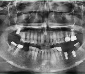 (Tiếng Việt) Nên làm cầu răng sứ hay trồng răng Implant????