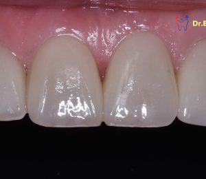 Change total smile with Emax-veneer