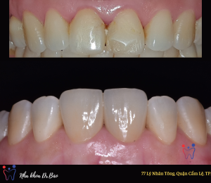 Change confident smile with 2 E-max veneer