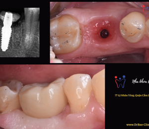 An implant tooth look like natural tooth