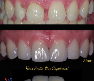 Change smile with 6 Emax veneer