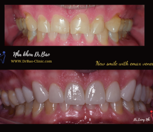 Change smile with 10 Emax veneer