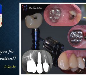 FULL MOUTH REHALIBITATION WITH IMPLANT AND ZIRCONIA CROWN