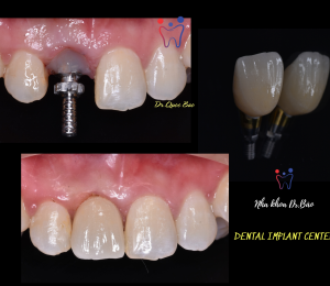 IMPLANT IN ESTHETIC ZONE