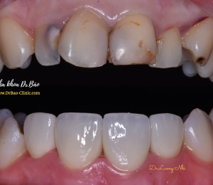 BRIGHTEN SMILE WITH ZIRCONIA CROWN