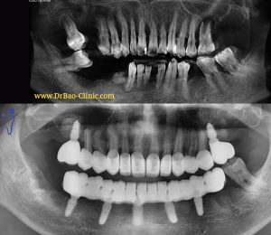 PHỤC HỒI RĂNG TOÀN HÀM VỚI IMPLANT ALL ON 5